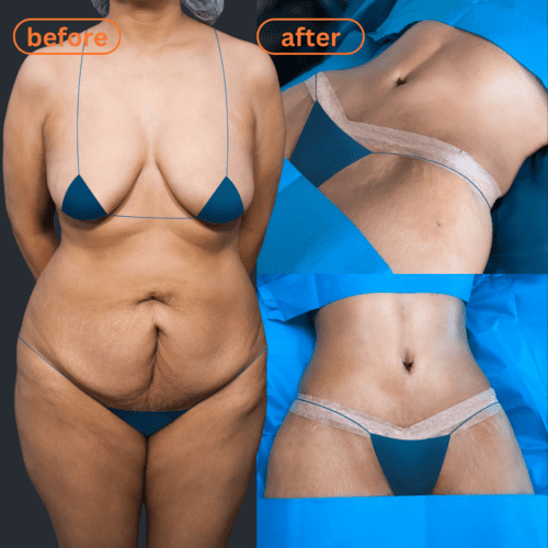 Drainless Circumferential Abdominoplasty